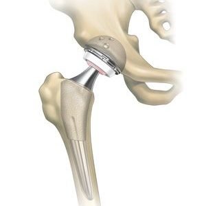 Hip Replacement _ Healthcare Services in Beloit, WI