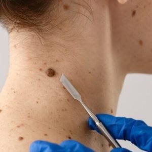 Can Surgical Dermatology Remove Moles